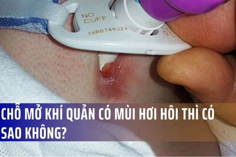 Chỗ mở khí quản có mùi hơi hôi thì có sao không?