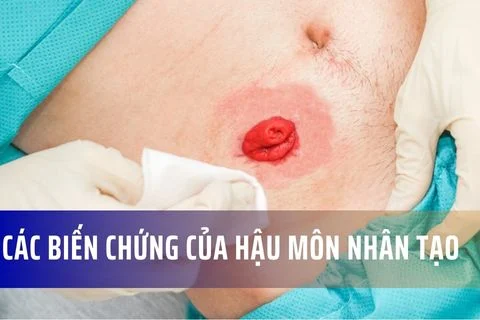Một số biến chứng phổ biến của hậu môn nhân tạo