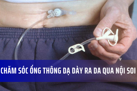Chăm sóc ống thông dạ dày ra da qua nội soi (PEG)