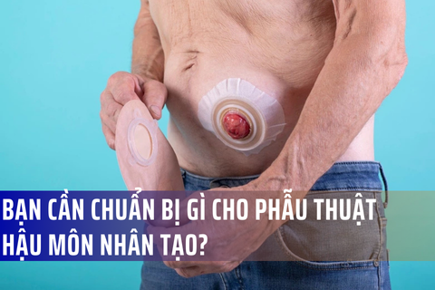 Chuẩn bị cho phẫu thuật hậu môn nhân tạo như thế nào?