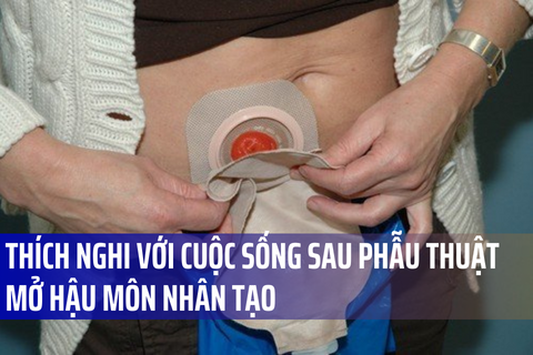 Có cần mang vớ giãn tĩnh mạch khi đi ngủ không?