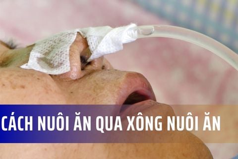 Cách nuôi ăn bằng xông nuôi ăn (dinh dưỡng qua đường ống)
