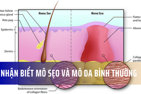Nhận biết mô sẹo và mô da bình thường