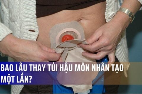 Bao lâu thay túi hậu môn nhân tạo một lần?
