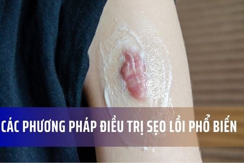 Các phương pháp điều trị sẹo lồi phổ biến