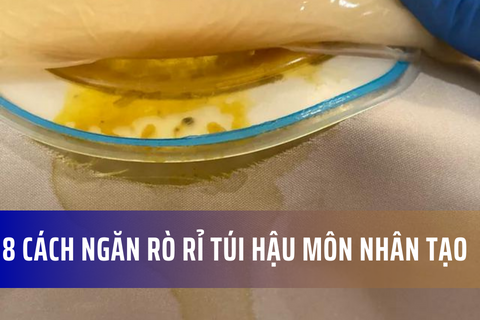 8 cách ngăn chặn rò rỉ túi hậu môn nhân tạo