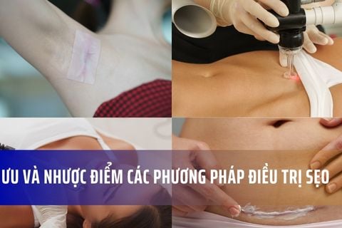 Ưu và nhược điểm các phương pháp điều trị sẹo