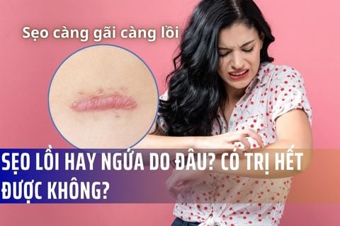 Sẹo lồi hay ngứa do đâu? Có trị hết được không?