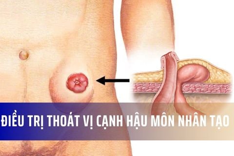 Cách điều trị thoát vị cạnh hậu môn nhân tạo