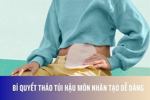 Bí Quyết Tháo Túi Hậu Môn Nhân Tạo Dễ Dàng