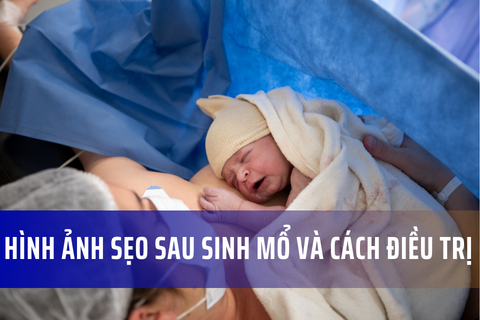 Sẹo mổ sau sinh: Hình ảnh vết mổ sau sinh bị lồi và Cách điều trị