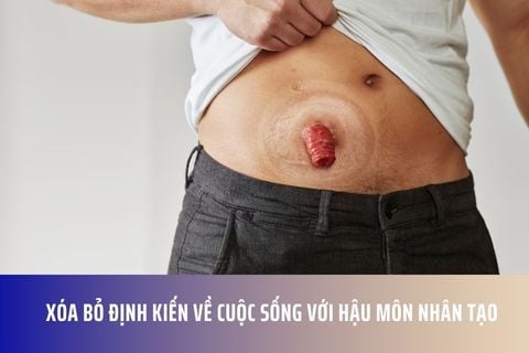 Xóa bỏ định kiến về cuộc sống với hậu môn nhân tạo