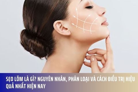 Sẹo Lõm Là Gì? Nguyên Nhân, Phân Loại Và Cách Điều Trị Hiệu Quả Nhất Hiện Nay