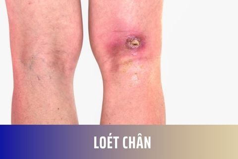 Loét chân