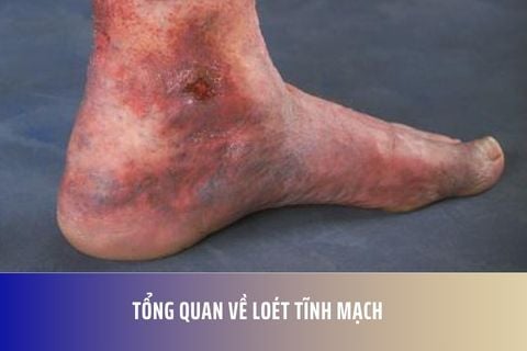 Tổng quan về loét tĩnh mạch