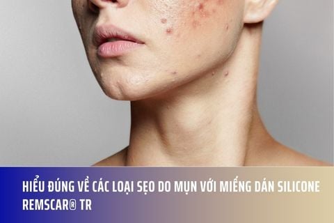 Hiểu Đúng Về Các Loại Sẹo Do Mụn Với Miếng Dán Silicone RemScar® TR