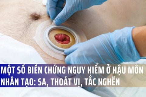 Biến chứng thường gặp ở hậu môn nhân tạo: Sa, thoát vị, tắc nghẽn